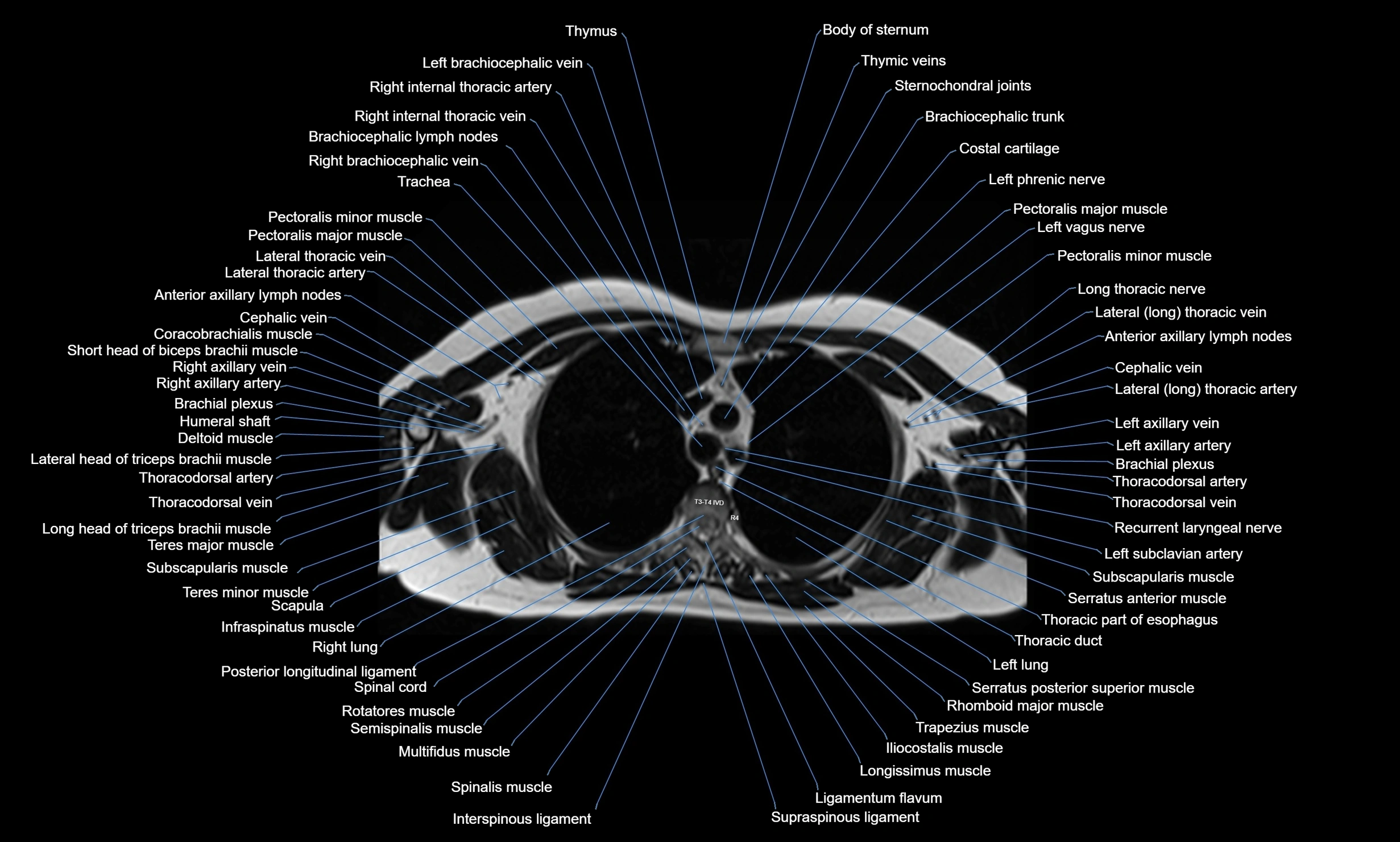 MRI chest axial  cross sectional anatomy 3T radiology  image-img-00001-00014.webp